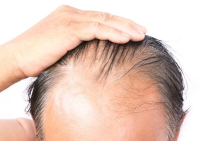Is Homeopathy Effective for Hair Fall Issues?
