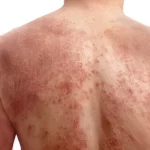 Battling the Flakes: Effective Psoriasis Skin Treatments
