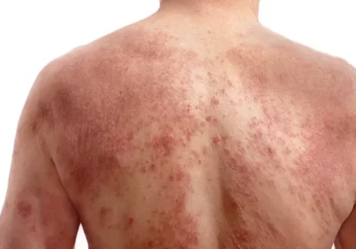 Battling the Flakes: Effective Psoriasis Skin Treatments