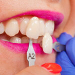 How to Take Care of Porcelain Veneers: The Ultimate Guide?