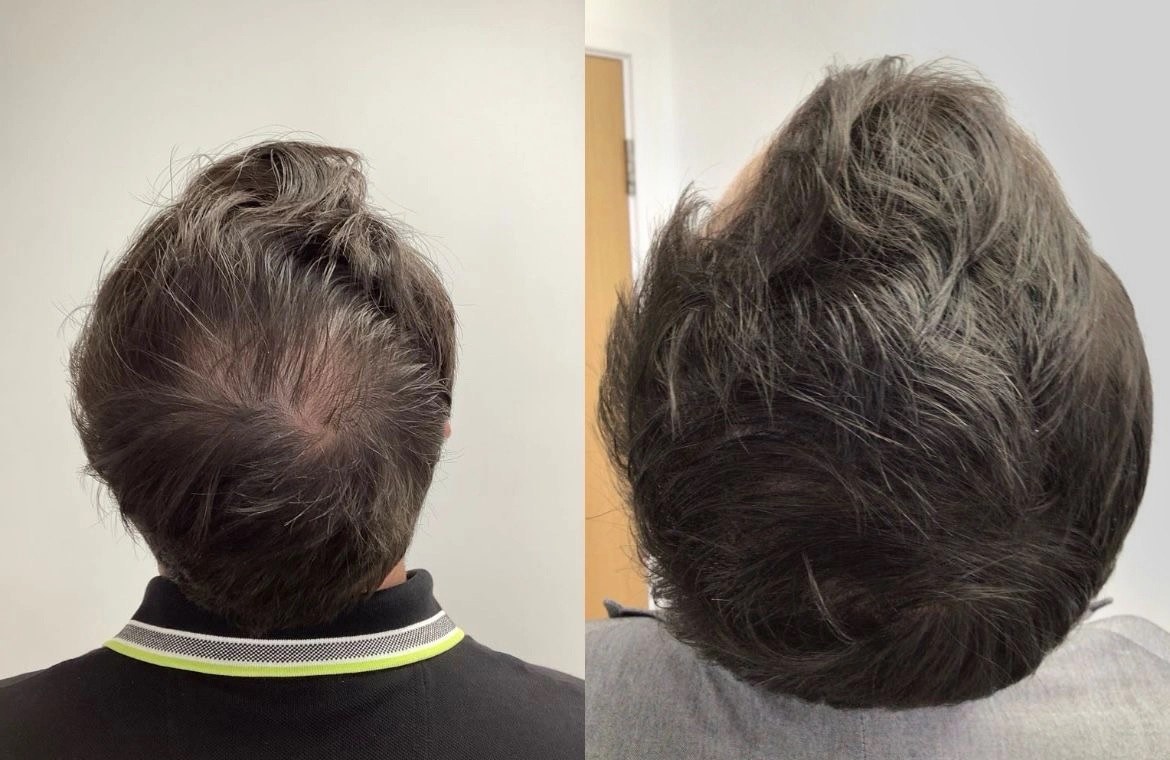 PRP for Hair Regrowth: Does It Really Work?