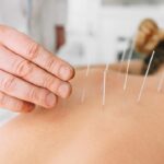 How Acupuncture Combines Ancient Wisdom with Modern Wellness?