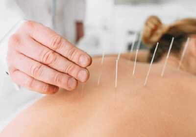 How Acupuncture Combines Ancient Wisdom with Modern Wellness?