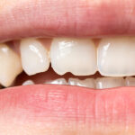 UNDERSTANDING A CHIPPED TOOTH: CAUSES, TREATMENT, AND CARE 