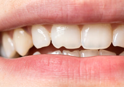 UNDERSTANDING A CHIPPED TOOTH: CAUSES, TREATMENT, AND CARE 