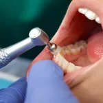 Why Plant Based Dental Materials Are Transforming Restorative Care